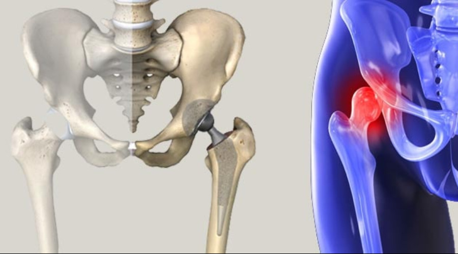 Robotik Total Kalça Protez Cerrahisi