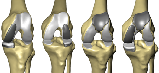 Robotik Unikondiller(Yarım, Kısmi) Protez Cerrahisi